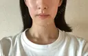 脂肪溶解注射（顔） 銀座フェイスクリニック（小顔整形・輪郭整形專門） DAY 7 サムネイル用
