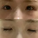 二重埋没 湘南美容クリニック 赤坂見附院 DAY 16 サムネイル用