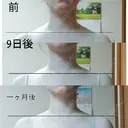 ボトックス（肩） もとび美容外科クリニック 新宿院 AFTER サムネイル用