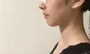 脂肪溶解注射（顔） 銀座フェイスクリニック（小顔整形・輪郭整形專門） DAY 8 サムネイル用