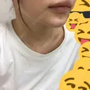 ヒアルロン酸注入（あご） / その他（輪郭） 東京形成美容外科 船橋院 DAY 0 サムネイル用