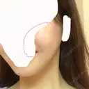 糸リフト / 脂肪吸引（顔） / その他（輪郭） / 切開リフト 清潭清楚整形外科 DAY 63 サムネイル用