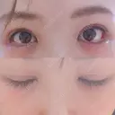 二重切開 / 眼瞼下垂（切開） / 目尻切開 ジュエリー美容外科 DAY 10 サムネイル用