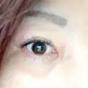 下まぶたの脂肪取り 湘南美容クリニック 千葉センシティ院 DAY 15 サムネイル用