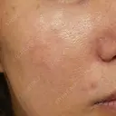 ピーリング（ニキビ・毛穴） / イオン導入 / フォトRF 湘南美容クリニック 長野院 DAY 7 サムネイル用