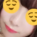 鼻尖形成（切開） / 鼻中隔延長（切開） / 軟骨移植 / 鼻翼基部形成（貴族手術） HANABI整形外科 DAY 27 サムネイル用