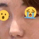 小鼻縮小（切開） / ヒアルロン酸注入（鼻） 東京形成美容外科 船橋院 DAY 13 サムネイル用