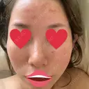 ピーリング（ニキビ・毛穴） / ダーマペン 麹町皮ふ科・形成外科クリニック DAY 3 サムネイル用