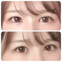 二重切開 / 上まぶたの脂肪取り 太田西ノ内病院 AFTER サムネイル用