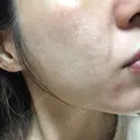 ダーマペン 品川美容外科 静岡院 DAY 3 サムネイル用