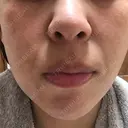 ダーマペン 品川美容外科 静岡院 AFTER サムネイル用
