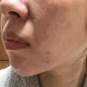 ダーマペン 品川美容外科 静岡院 DAY 4 サムネイル用