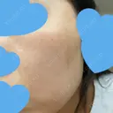 ピコレーザートーニング（美白・肝斑） UB CLINIC銀座 DAY 17 サムネイル用