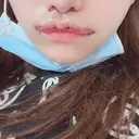 人中短縮 / 口角挙上 / その他（口元） 清潭女神美容外科 AFTER サムネイル用
