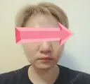 糸リフト / レディエッセ注入（鼻） トアロード形成美容クリニック DAY 12 サムネイル用