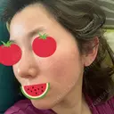 ピーリング（ニキビ・毛穴） / ダーマペン 麹町皮ふ科・形成外科クリニック DAY 5 サムネイル用
