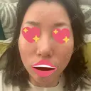 ピーリング（ニキビ・毛穴） / ダーマペン 麹町皮ふ科・形成外科クリニック AFTER サムネイル用