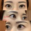 眉下切開 湘南美容クリニック 秋葉原院 DAY 95 サムネイル用