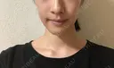 脂肪溶解注射（顔） 銀座フェイスクリニック（小顔整形・輪郭整形專門） DAY 14 サムネイル用