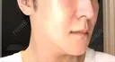 骨切り（あご） / 骨削り（エラ） 加藤クリニック 麻布東京院 DAY 30 サムネイル用