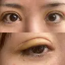 二重切開 / 眼瞼下垂（切開） / 目元修正 シエルクリニック DAY 7 サムネイル用