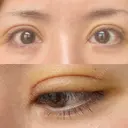 二重切開 / 眼瞼下垂（切開） / 目元修正 シエルクリニック DAY 8 サムネイル用