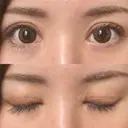 二重切開 / 眼瞼下垂（切開） / 目元修正 シエルクリニック DAY 9 サムネイル用