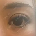 二重切開 / 眼瞼下垂（切開） / 目元修正 シエルクリニック DAY 9 サムネイル用