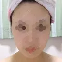 ボトックス（エラ・小顔） 湘南美容クリニック 静岡院 DAY 21 サムネイル用