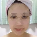 ボトックス（エラ・小顔） 湘南美容クリニック 静岡院 DAY 21 サムネイル用