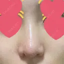 鼻尖形成（切開） / 小鼻縮小（切開） / 軟骨移植 湘南美容クリニック 大阪心斎橋院 DAY 16 サムネイル用