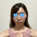 脂肪溶解注射（顔） 赤坂プレミアクリニック AFTER サムネイル用