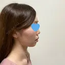 脂肪溶解注射（顔） 赤坂プレミアクリニック DAY 14 サムネイル用