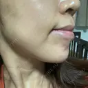 ボトックス（あご） / ヒアルロン酸注入（あご） 湘南美容クリニック 大阪京橋院 DAY 16 サムネイル用