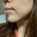 ボトックス（あご） / ヒアルロン酸注入（あご） 湘南美容クリニック 大阪京橋院 DAY 16 サムネイル用