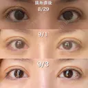 二重切開 / 眼瞼下垂（切開） / 目元修正 シエルクリニック DAY 10 サムネイル用