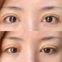 二重切開 / 眼瞼下垂（切開） / 目元修正 シエルクリニック DAY 10 サムネイル用