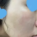 ピコレーザートーニング（美白・肝斑） UB CLINIC銀座 DAY 20 サムネイル用