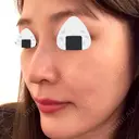 スレッドノーズ / その他（肌） キップン整形外科 DAY 15 サムネイル用