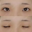 二重埋没 湘南美容クリニック 赤坂見附院 DAY 31 サムネイル用