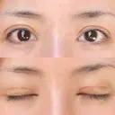 二重切開 / 眼瞼下垂（切開） / 目元修正 シエルクリニック DAY 11 サムネイル用