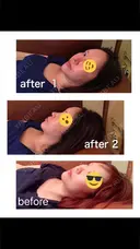 糸リフト / 骨切り（あご） / 骨削り（エラ） / 骨削り（頬） / 脂肪吸引（顔） / 輪郭修正 / 脂肪注入（額） / 脂肪注入（輪郭） / ハイフ（顔） GIRIN（ギリン）美容外科 DAY 341 サムネイル用