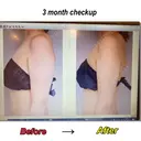 脂肪吸引（二の腕） Mods Clinic（モッズクリニック） 東京院 DAY 92 サムネイル用