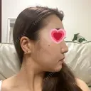 骨切り（あご） / 骨削り（エラ） / 骨削り（頬） バノバギ整形外科 DAY 198 サムネイル用