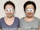 切開リフト 石倉クリニック 水戸院 DAY 30 サムネイル用