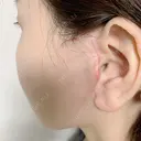 切開リフト 石倉クリニック 水戸院 DAY 30 サムネイル用