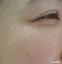 シワ取りボトックス 湘南美容クリニック 仙台院 DAY 51 サムネイル用