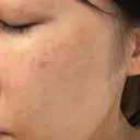 シミ取りレーザー / YAGレーザー 仁愛クリニック DAY 93 サムネイル用