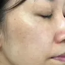 シミ取りレーザー / YAGレーザー 仁愛クリニック DAY 93 サムネイル用