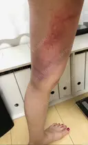 クマ治療 / 脂肪吸引（脚） / 下まぶたたるみ取り / 下まぶたの脂肪取り 湘南美容クリニック 千葉センシティ院 DAY 2 サムネイル用